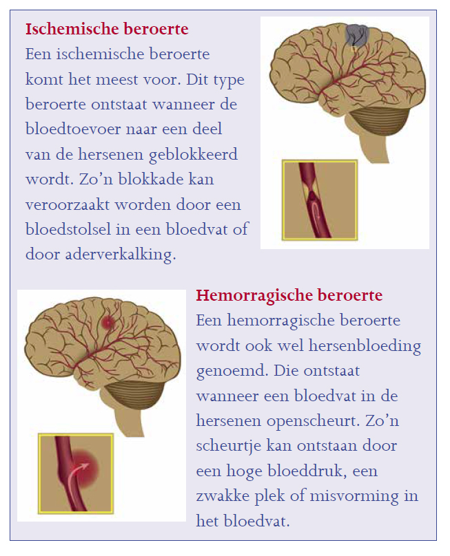 Ischemische beroerte